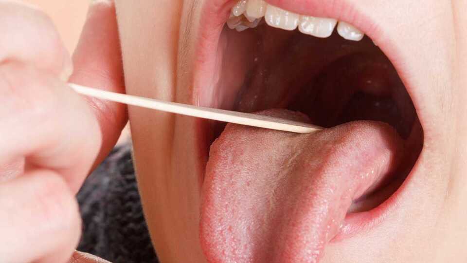 Bademcik şişmesine ne iyi gelir?