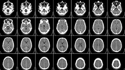 Obez çocukların beyinlerinde farklılık gözlendi