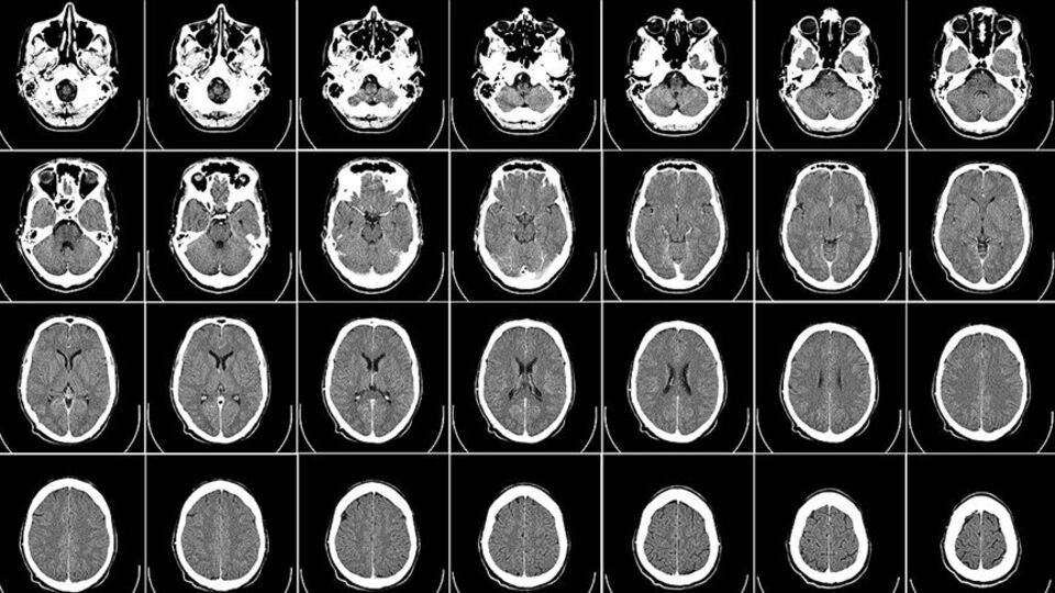 Obez çocukların beyinlerinde farklılık gözlendi