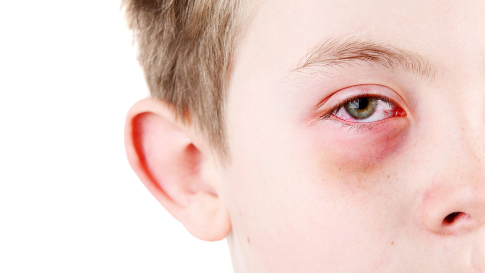 Göz alerjisi belirtileri, nedenleri ve tedavisi nasıl yapılır?