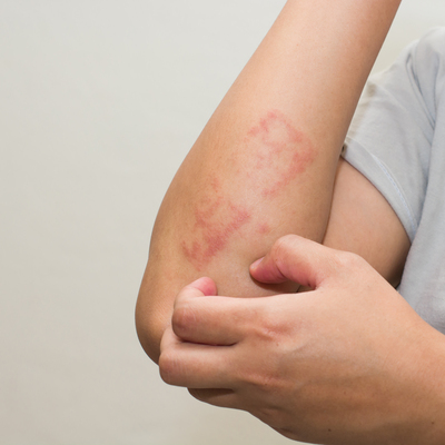 Şaşırtıcı ama! Bu kanserin nedeni güneş değil