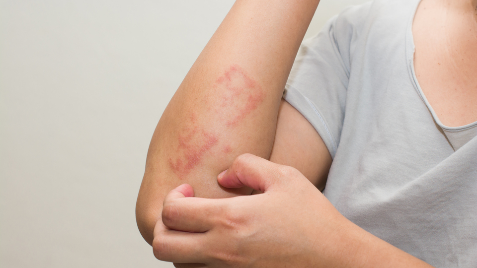 Şaşırtıcı ama! Bu kanserin nedeni güneş değil