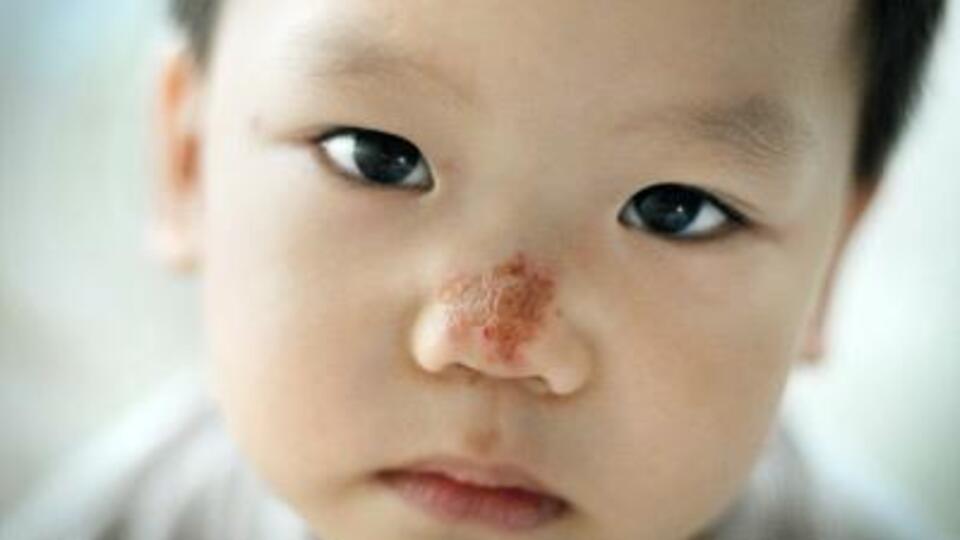 İmpetigo nedir?