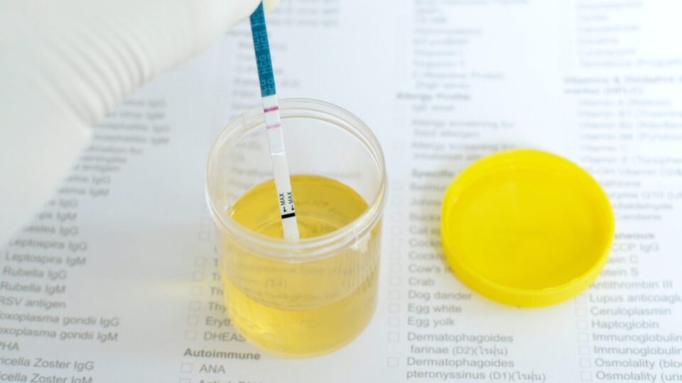 İdrarda protein kaçağı belirtileri nelerdir?