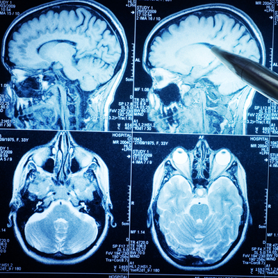 Alzheimer'ı bitirecek buluş!