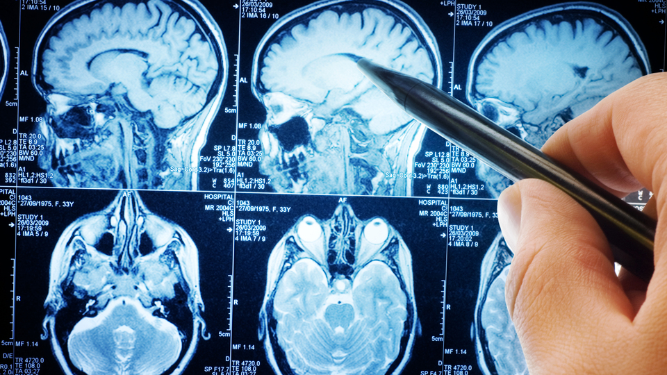 Alzheimer'ı bitirecek buluş!