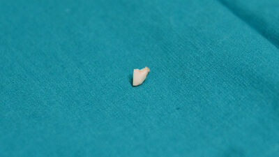 Akciğerine badem kaçtı!