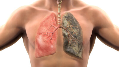 Sigara akciğer kanseri riskini 30 kat artırıyor