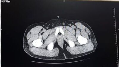 Midesinden 1,2 kg. uyuşturucu çıktı