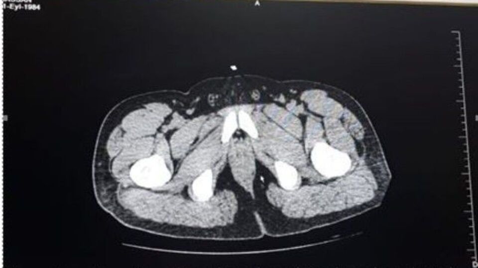 Midesinden 1,2 kg. uyuşturucu çıktı