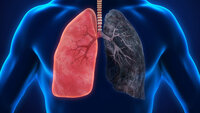 Akciğer kanserinin belirtileri!