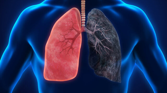 Akciğer kanserinin belirtileri!