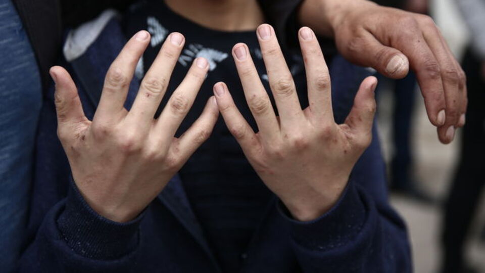 Salgın kapıda! Bu belirtilere dikkat!