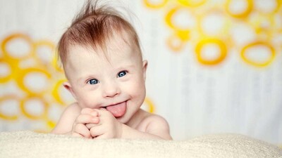 Mongolizm hastalığı nedir? Belirtileri ve teşhisi nasıldır?