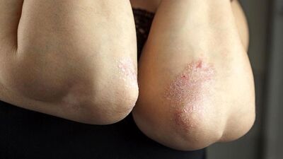 Sedef hastalarına uyarı!