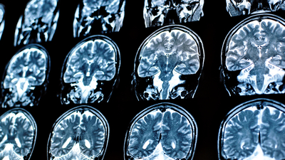 Beynini tenyalar sardı!