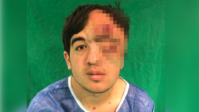 Göz çukuruna bile yayıldı! Kafatası ve beyni açıkta kalınca...