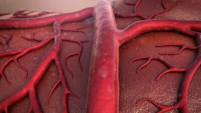 Damar (Aort) genişlemesi nedir, neden olur, nedenleri ve belirtileri nelerdir?