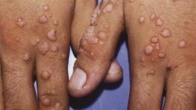 Siğile nedir, el ve ayakta siğillerin nedenleri, kimlerde daha sık görülür?