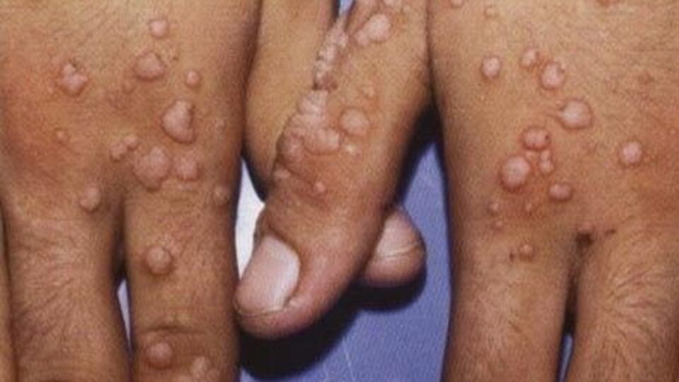 Siğile nedir, el ve ayakta siğillerin nedenleri, kimlerde daha sık görülür?