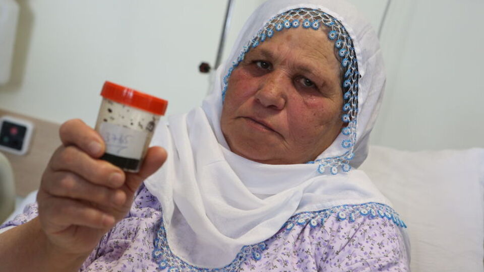 Safra kesesinden çıktı! 4 kişi 1 saatte saydı...