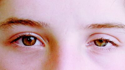 Göz kapağı düşüklüğü nedir? Göz kapağı düşüklüğü tedavisi