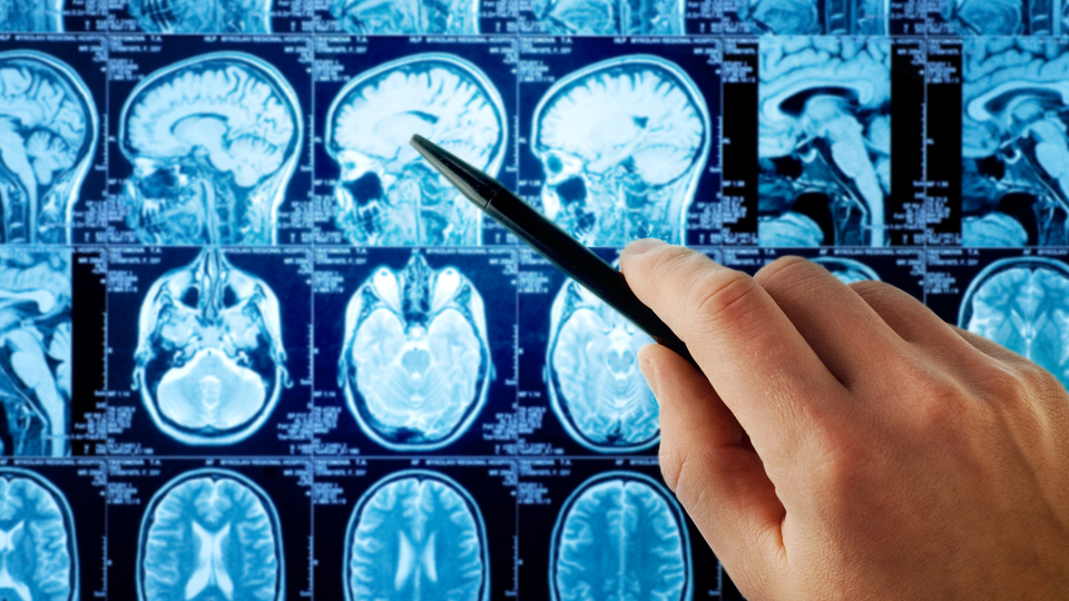 Serebral Palsi nedir?