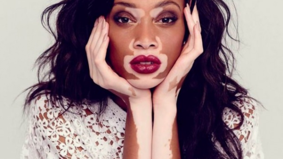 Vitiligo nedir? Vitiligo neden olur, nasıl tedavi edilir?