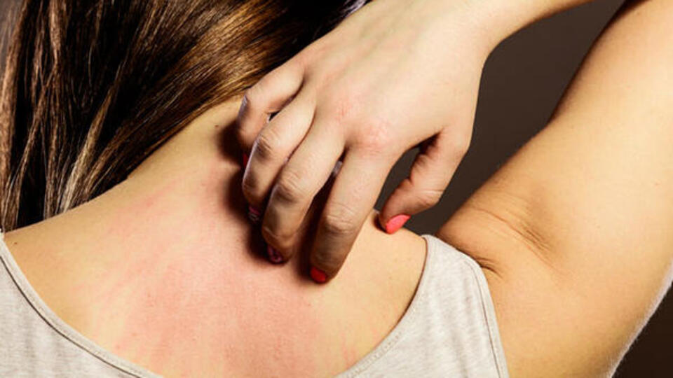 Uyuzun belirtileri nelerdir?