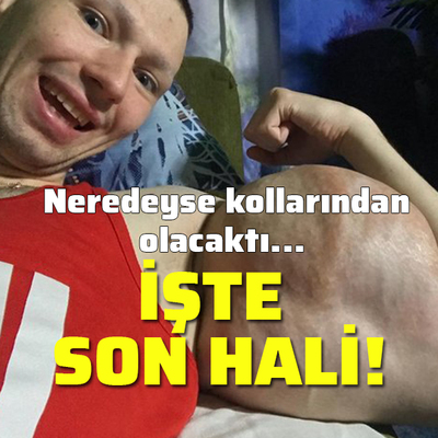 Kolları olay olmuştu! İşte son hali...