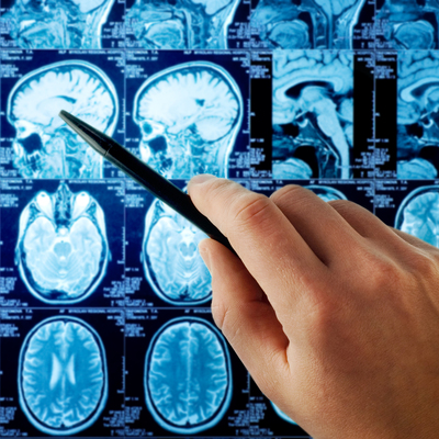 Alzheimer sandılar! Beyninden öyle bir şey çıktı ki...