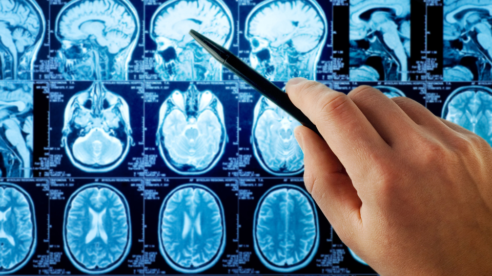 Alzheimer sandılar! Beyninden öyle bir şey çıktı ki...