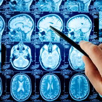 O erkeklere uyarı! Alzheimer olabilirsiniz...