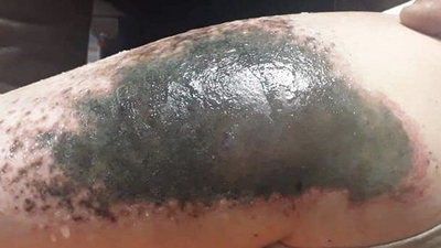 Kar topu oynayan çocukların vücudu neden yandı?