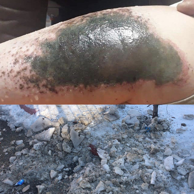 Kar topu oynayan çocukların vücudu neden yandı?