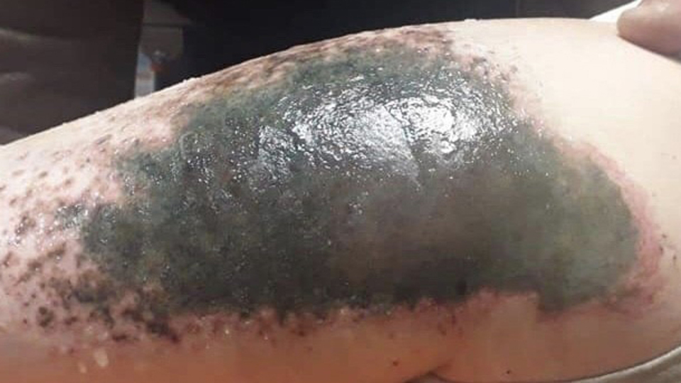 Kar topu oynayan çocukların vücudu neden yandı?