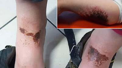 Karla oynuyorlardı! Yanan 2 çocuğa doku nakli!