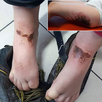 Karla oynuyorlardı! Yanan 2 çocuğa doku nakli!