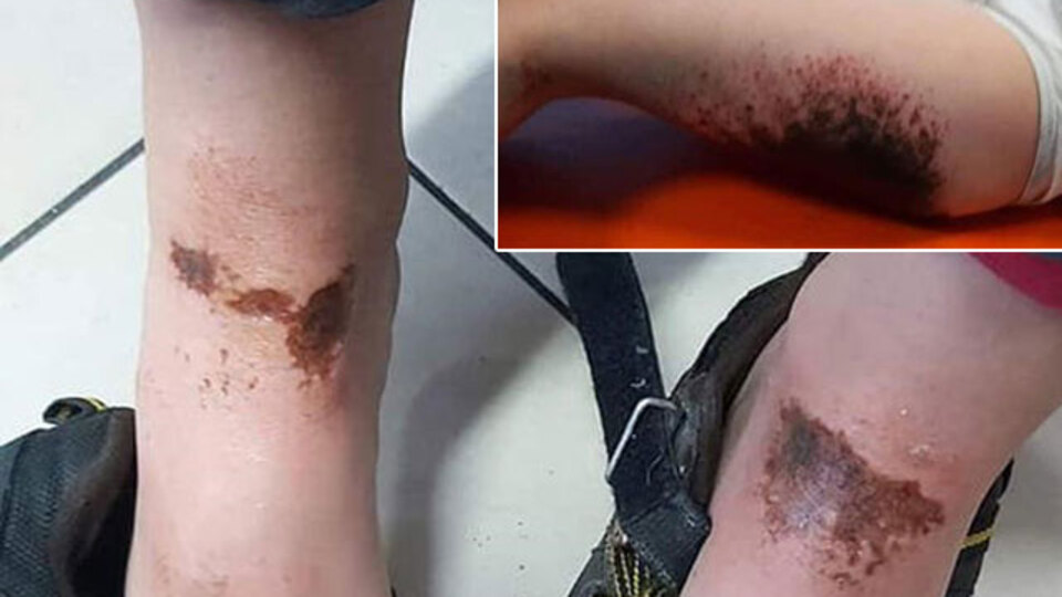 Karla oynuyorlardı! Yanan 2 çocuğa doku nakli!