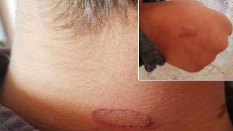 Öğretmenden kızgın soba maşasıyla şiddet!