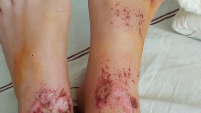 'Gizemli yanıklar' için çarpıcı tespit