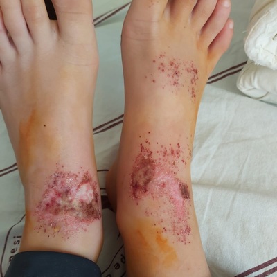 'Gizemli yanıklar' için çarpıcı tespit