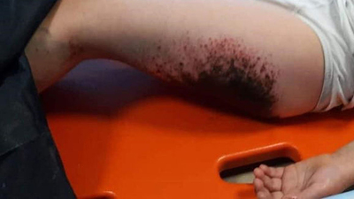 Gizemli yanığın sebebi ortaya çıktı!