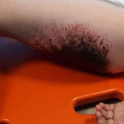 Gizemli yanığın sebebi ortaya çıktı!