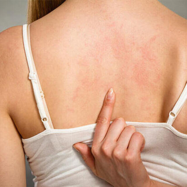 Ürtiker (kurdeşen) nedir? Belirtileri ve tedavisi nasıldır?