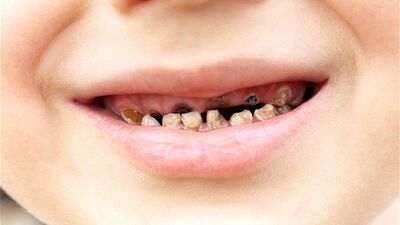 Diş çürüğü nasıl oluşur?