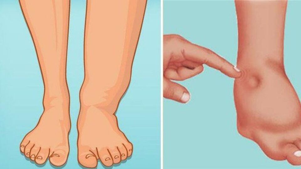 Ödem nasıl atılır?