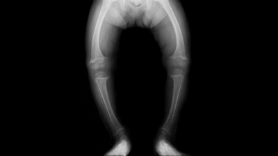 Raşitizm hastalığı nedir?