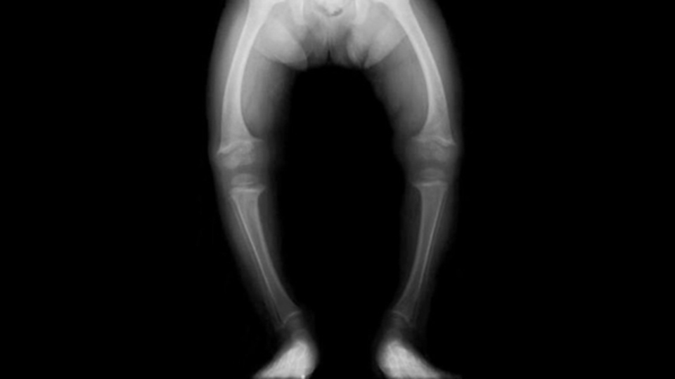 Raşitizm hastalığı nedir?