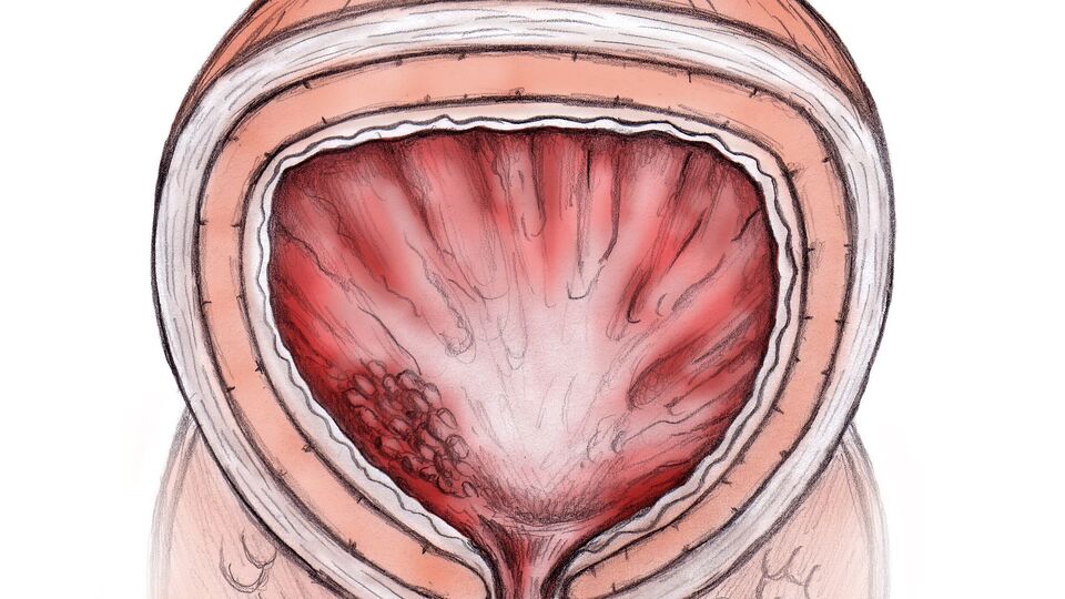Prostat hastalığı nedir?